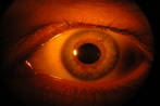 Auge - Auge durch eine Spaltlampe beobachtet.